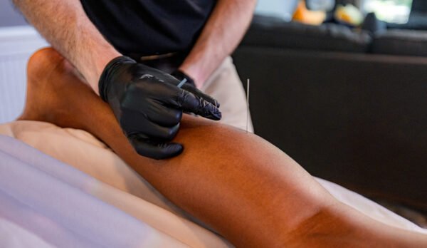 5 Dry Needling Image 5